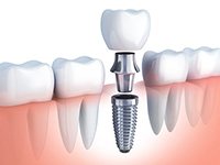 A 3D illustration of a single-tooth dental implant