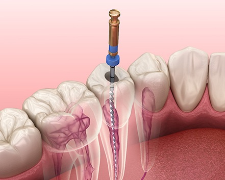 Illustration of tooth receiving root canal therapy in Center, TX