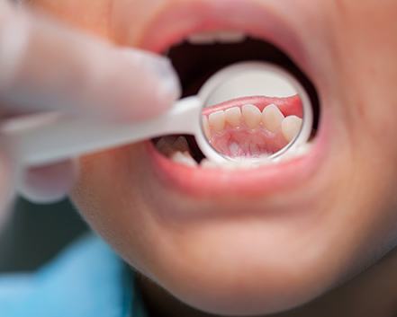 Dental mirror used to check child’s teeth